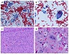 Recognizing the Limitations and Pitfalls of Cytology for Anaplastic Carcinoma within Hürthle Cell (Oncocytic) Carcinomas