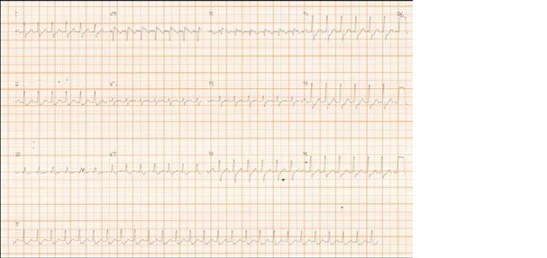 Non-Sustained Polymorphic Ventricular Tachycardia Following Modified Valsalva Maneuver: A Case Report