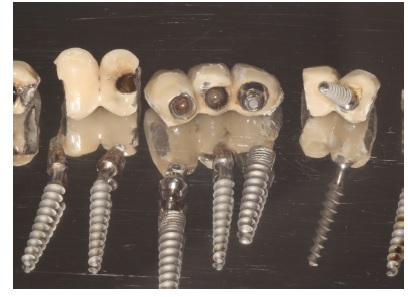 Retrospective Research of Removing Dental Implants
