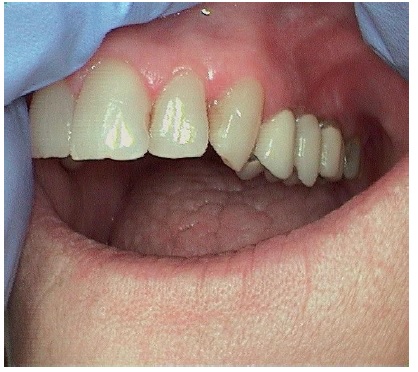 The Malignant Transformation of Oral Lichen Planus and Oral Lichenoid Lesions, a Case Report and Review of the Literature