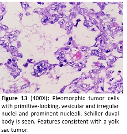 Ovotesticular Mixed Germ Cell Tumor in a 46, XY/46, XX Hermaphrodite: A Case Report