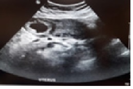 Combined Medical and Surgical Management of Unruptured Large Interstitial Ectopic pregnancy: Case Report and Literature Review