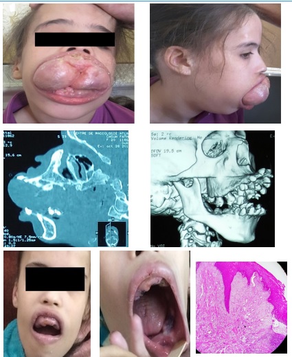 A Historic Case Report of Idiopathic Gingival Fibromatosis In Childhood and Its Management