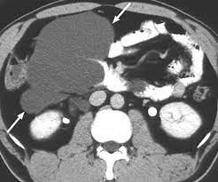 Large Primary Retroperitoneal Mucinous Cystadenoma managed Laparoscopically: Case Report and Literature Review
