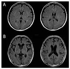 Exploring the Determinants of Childhood Brain Atrophy: A Study in Northern Tanzania