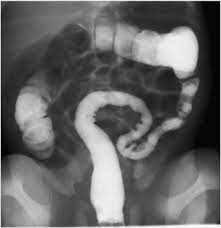 Neonatal Small Left Colon Syndrome in a Baby of Nondiabetic Mother: A Case Report