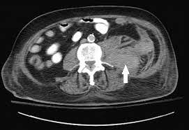 Spontaneous Retroperitoneal Haematoma Following Caesarean Section. Case Report and Review of the Literature