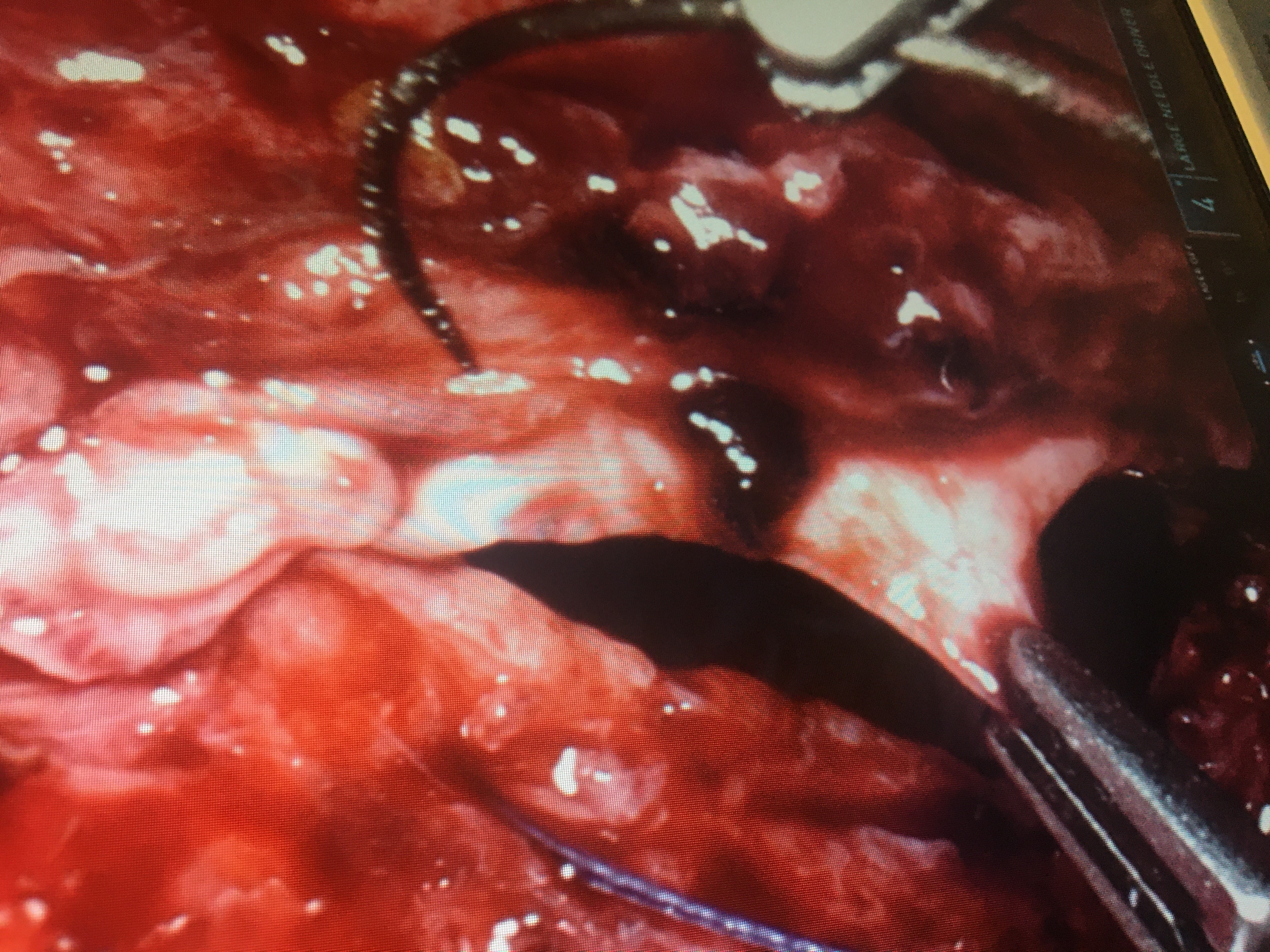 Case Report: Spontaneous Bladder Rupture after Intense Vomiting in a 25-YearOld Young Man, Surgically Treated with Robotic Method
