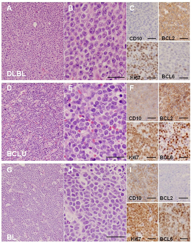 B-Cell Lymphoma Unclassifiable with Features Intermediate between Diffuse Large B-Cell Lymphoma and Burkitt’s Lymphoma: Comparison Study of Clinical Outcome and Treatment Response