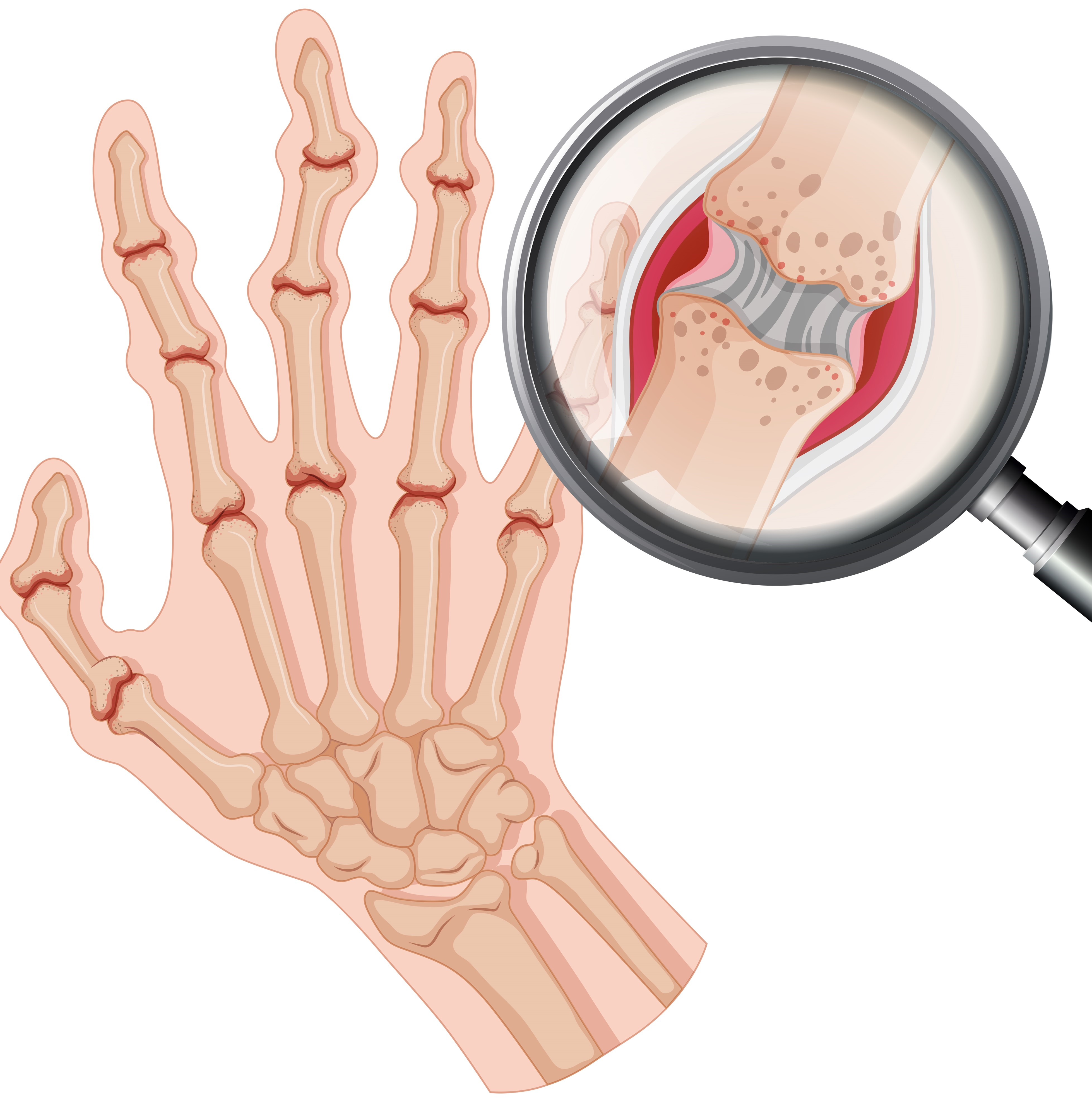 Evolution of Axial Radiographic Damage in Patients with Psoriatic Arthritis: Relationship with Clinical Factors, Laboratory, and Ultrasound Enthesis Findings