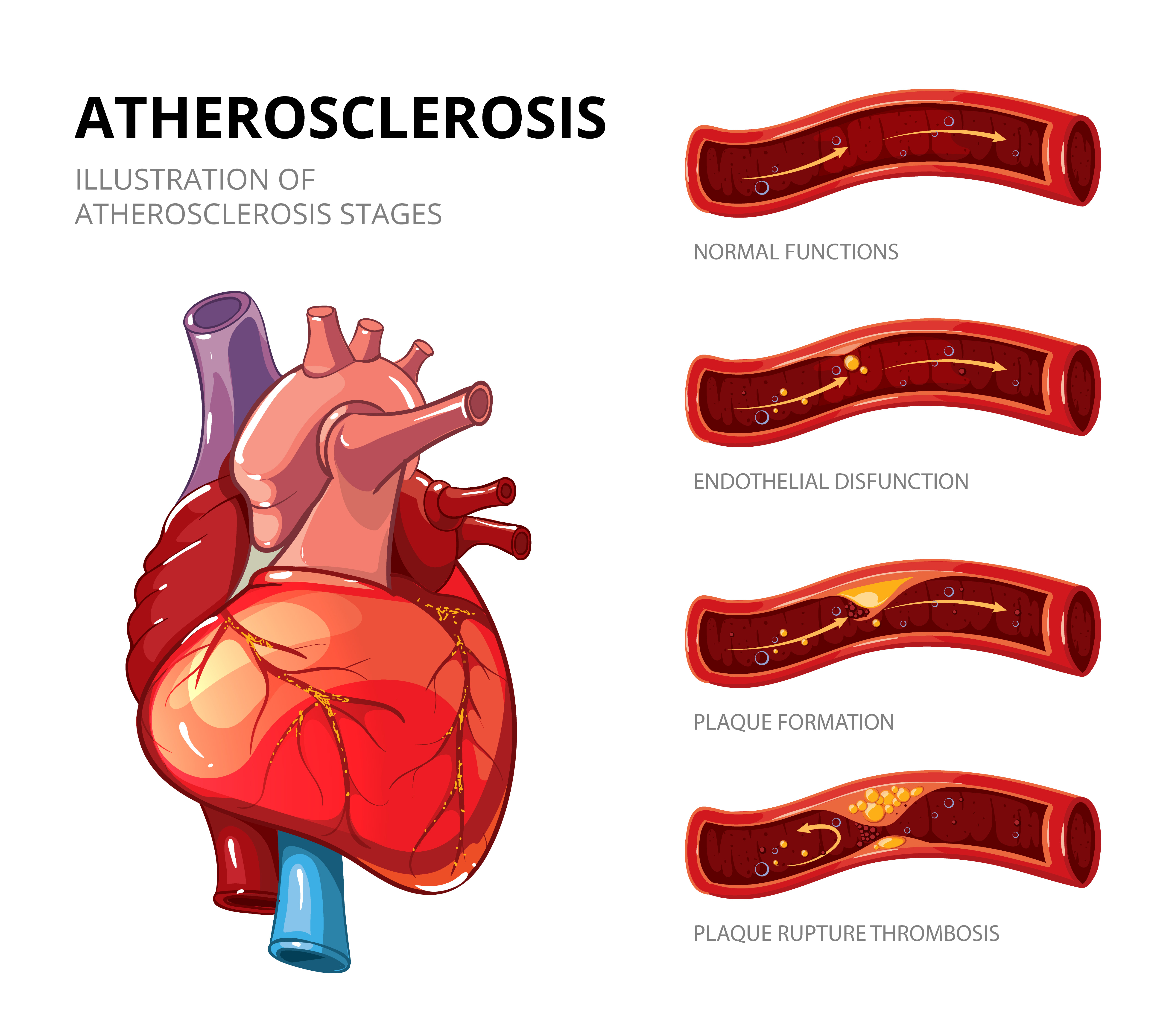 Age and Gender Specific Reference Values of Brachial Flow-mediated Dilation and Carotid Intima-media Thickness in CATHAY Study: Atherosclerosis Surrogate Markers in Chinese Adults