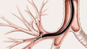 Historical Highlights of Endobronchial Metastases 