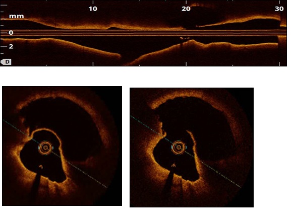 A Case of Percutaneous Coronary Intervention Using A Polytetrafluorethylene-Covered Stent For An Iatrogenic Pseudoaneurysm Of The Left Main Coronary Artery