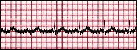 Signal Processing Techniques for Removing Noise from ECG Signals