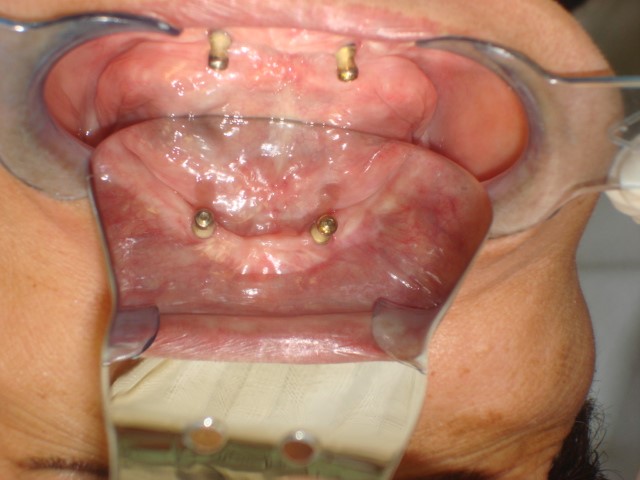Mandibular Two-Implant Retained Overdenture in A Patient with Parkinson’s Disease: A case report