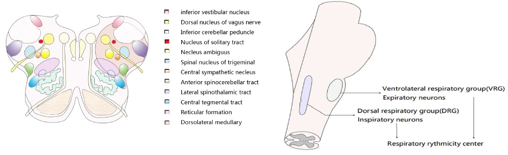 Ondine’s Curse：A Patient with Medullary Dorsolateral Infarction