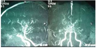 A Case Report on Moyamoya Disease