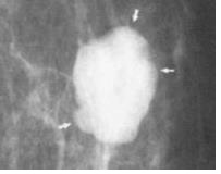 Planimetry: An Option for Diagnosis in Non-Palpable Lesions of the Breast