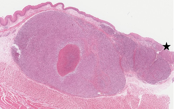 Follicular Dendritic Cell Sarcoma of the Esophagus - A Case Report