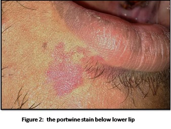 Acquired Portwine Stain on the Face in An Adult: A Case Report and Review
