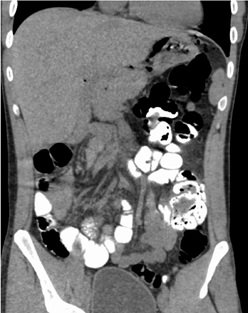 Adult Midgut Malrotation: A Case Report