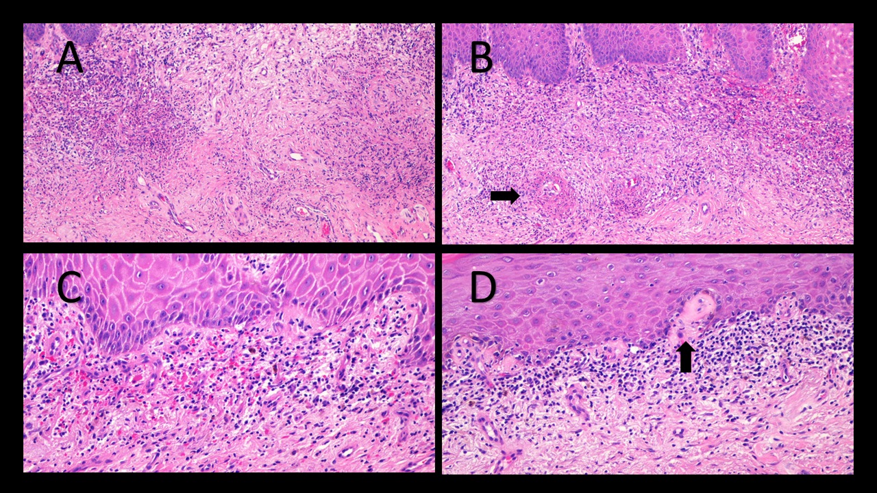 Acute Kidney Injury in Snake Bite Cases – A Cross-Sectional Study