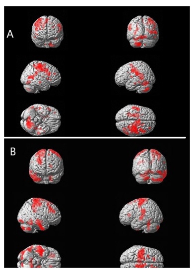 Functional Recovery After Bone Marrow Derived Stem Cells in Stroke- A fMRI & Growth Factor Correlation