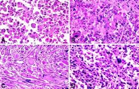 Pleomorphic Rhabdomyosarcoma in Adult: A Very Uncommon Occipital Location