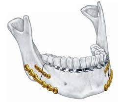 Incidence of Mandibular Fractures in A Public Hospital in Venezuela: Ten Years Experience