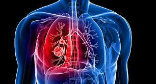 Clinical Management of Advanced Lung Cancer Patients During the Outbreak Of COVID-19 Epidemic
