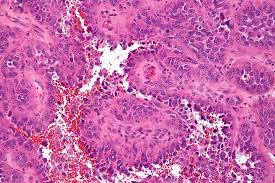 Angiosarcoma Tumor – An Unusual Localization of a Rare Tumor: A Case Report