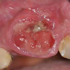 Non-Hodgkin’s Brain Lymphoma with Localized Metastasis to soft and hard palate, A Case Report and Review of the Literature Pacific Northwest Kaiser, USA