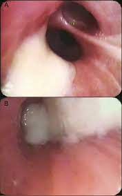 Endobronchial Paracoccidioidomycosis - Case Report