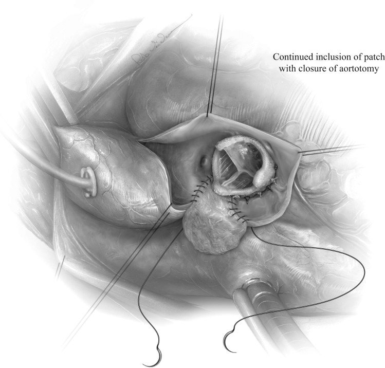 A Large Saccular Pseudo Aneurysm of Ascending Aorta- A Rare Post-Operative Complication of Aortic Annulus Enlargement