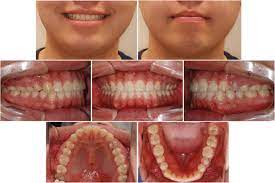 A Simple and Effective Palatal Splint to Improve Stability of Segmental Lefort I Osteotomy: Technical Note