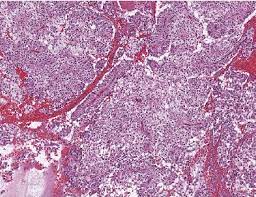 Parenchyma-Sparing Procedure and Solid Pseudopapillary Neoplasm. A Case Report