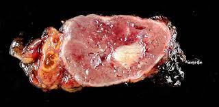 A Rare Non-Functional Bladder Paraganglioma Managed by Transurethral Resection