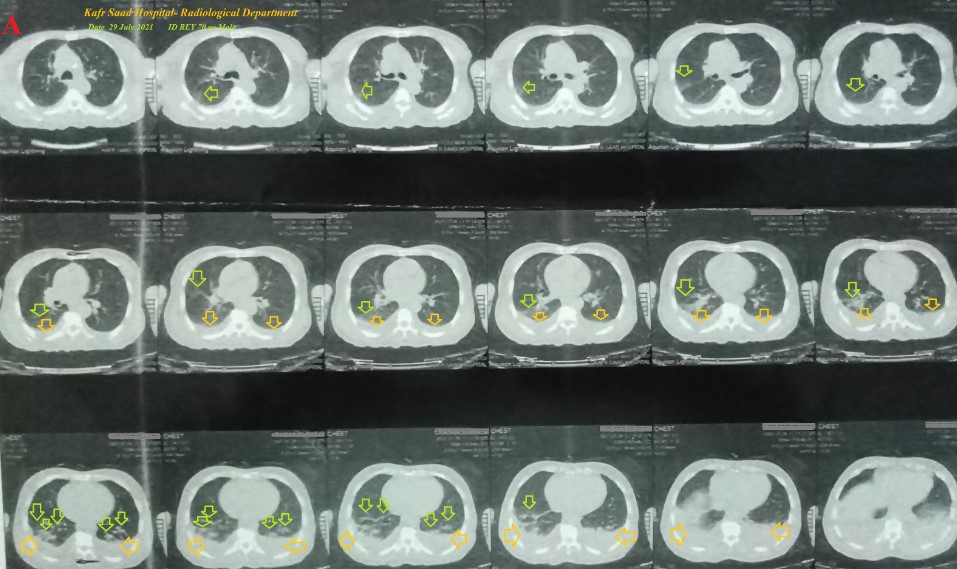 Zavras-Kounis Syndrome Simultaneously with Reactional Myoclonus Post-Streptokinase in Covid-19 Inducing Myocardial Infarction; Interpretation and Serious Implications 