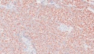 Molecular detection and characterization of aneuploid CD31- CTCs and CD31+ CTECs expressing EpCAM or Ki-67 in the comprehensive diagnosis of a rare case of Merkel cell carcinoma