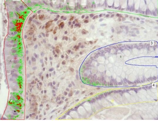 Human β-Defensins in Colonic Mucosa of Patients with Irritable Bowel Syndrome, Inflammatory Bowel Disease and Healthy Controls – A Pilot Study