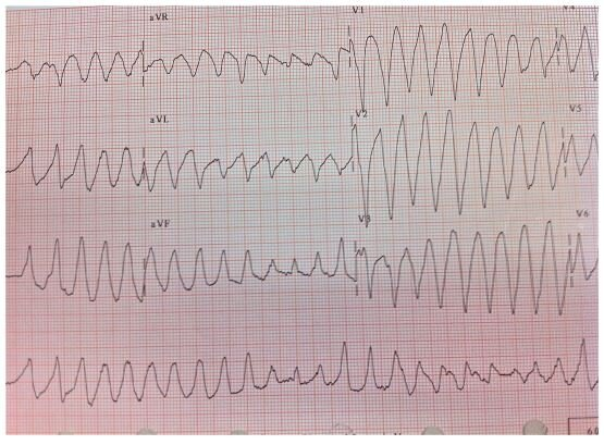 Ciprofloxacin Induced Torsades De Pointes – A Case Report