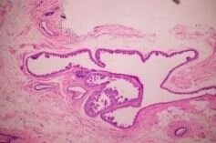 Breast Ductal Adenoma: Confusion with Carcinoma is Real